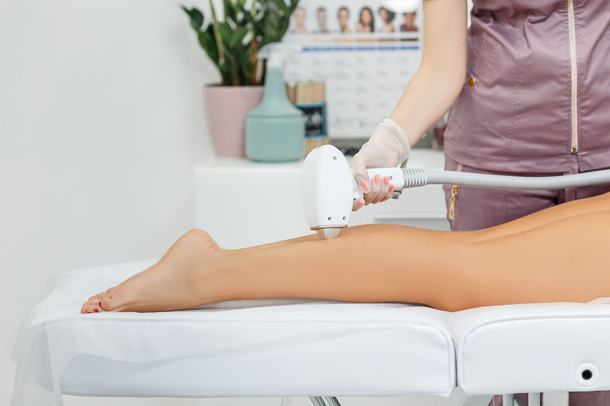 epilazione laser a cuneo